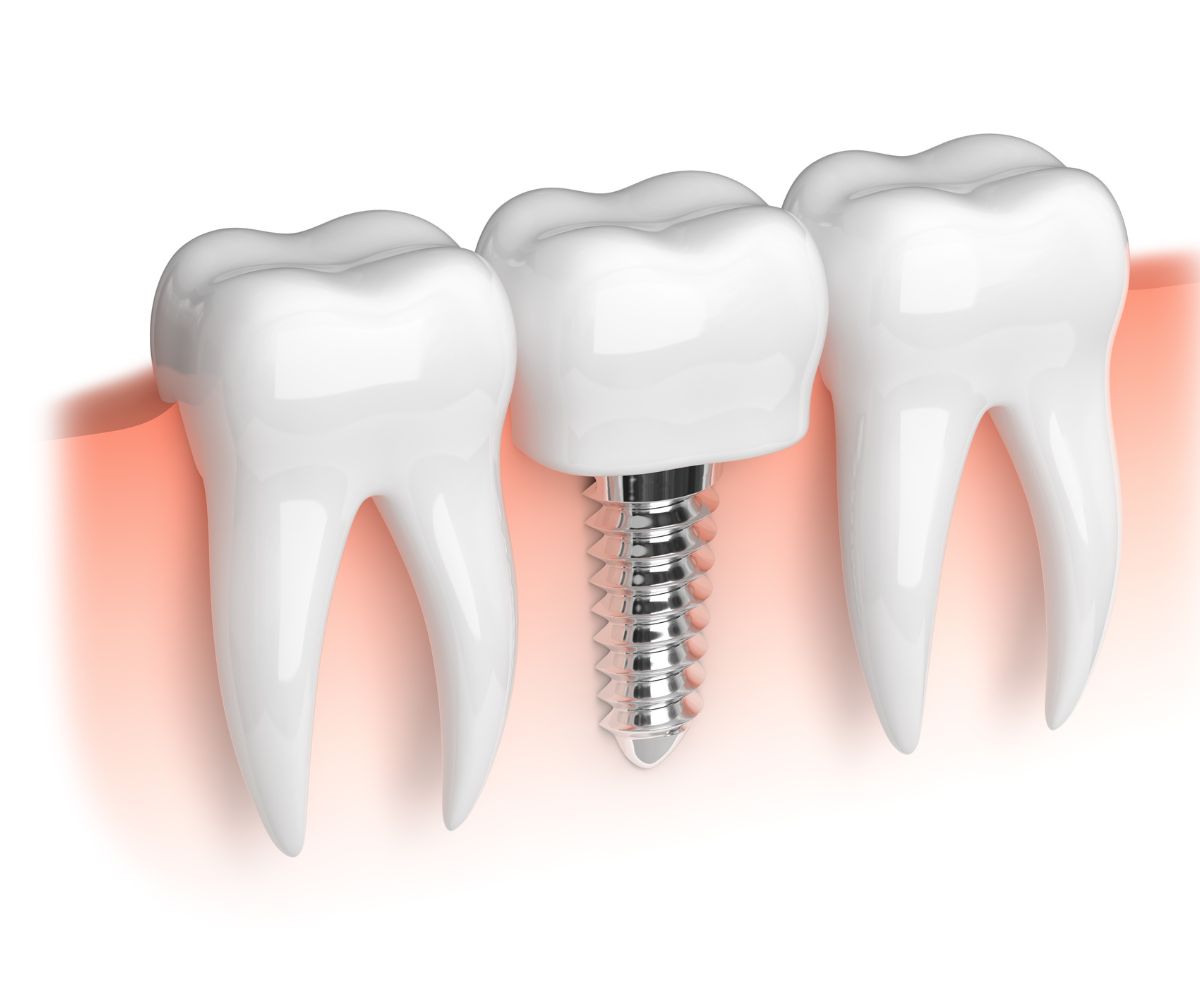 Implante Dentario Imediato