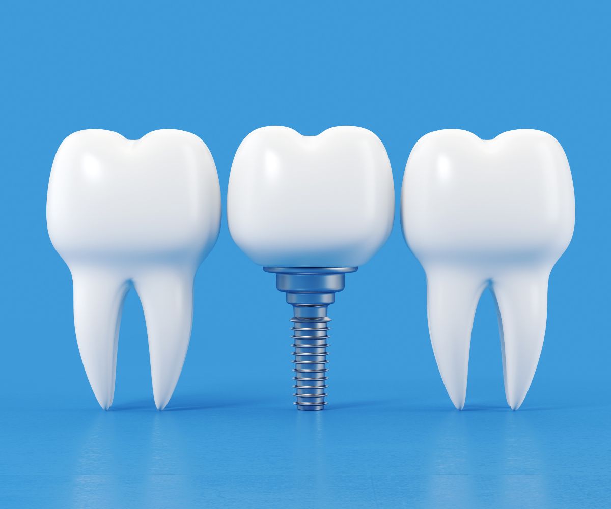 implante dentário inferior